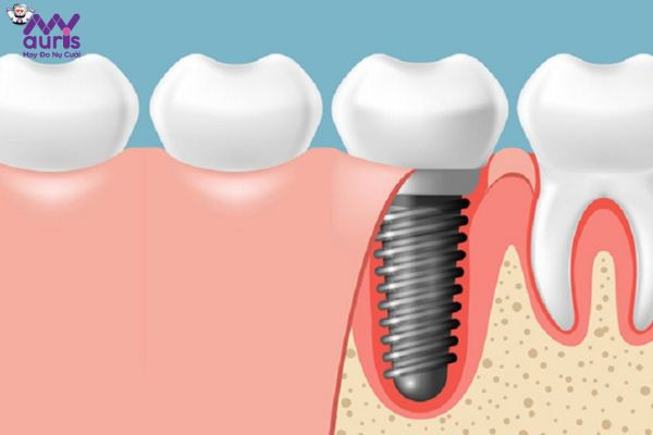 Chi phí trồng răng Implant 