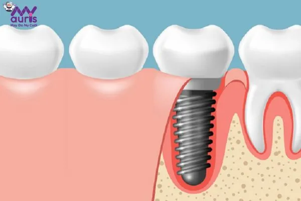 Chi phí trồng răng Implant 