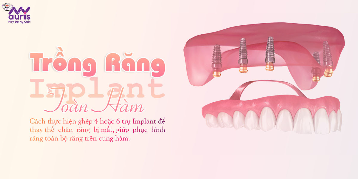 trồng răng implant toàn hàm