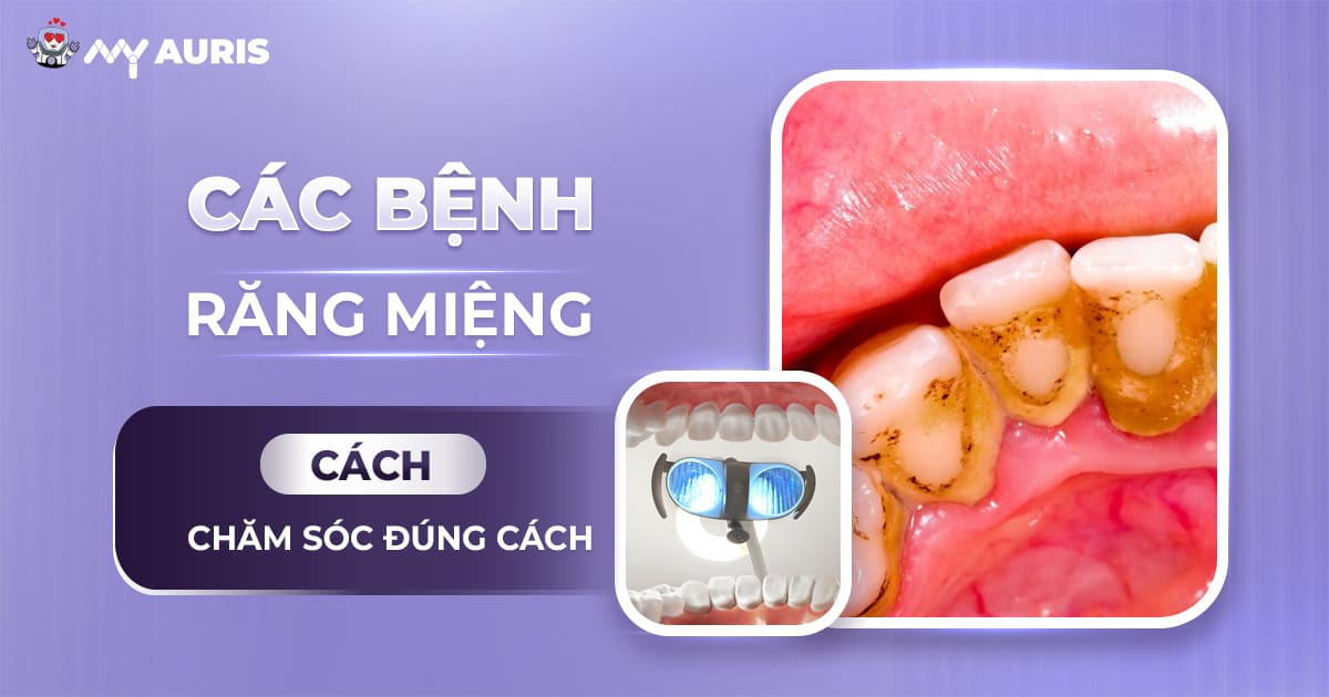 các bệnh răng miệng