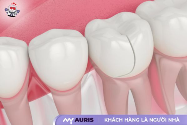 bắc cầu răng sứ, bac cau rang su