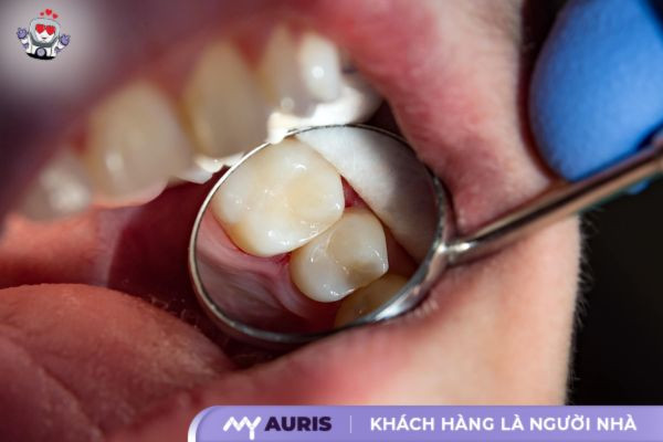 biểu hiện sau khi bọc răng sứ,sau khi bọc răng sứ