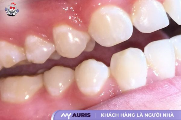 biểu hiện sau khi bọc răng sứ,sau khi bọc răng sứ