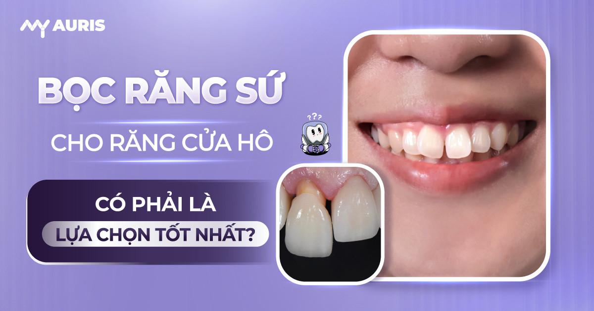 bọc răng sứ cho răng cửa hô