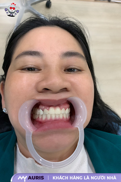 bọc răng sứ có hết móm không