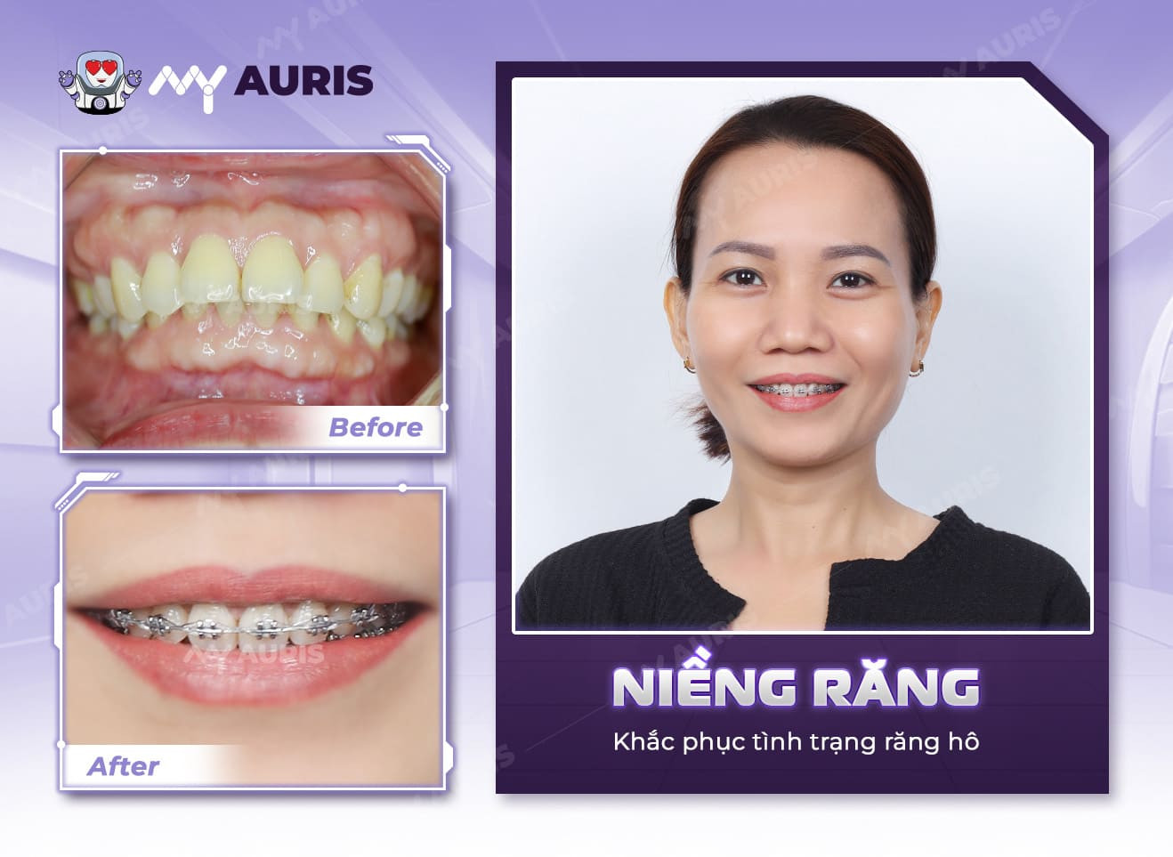 bọc răng sứ có niềng răng được không,bọc răng sứ có niềng được không,làm răng sứ có niềng răng được không,răng sứ có niềng được không