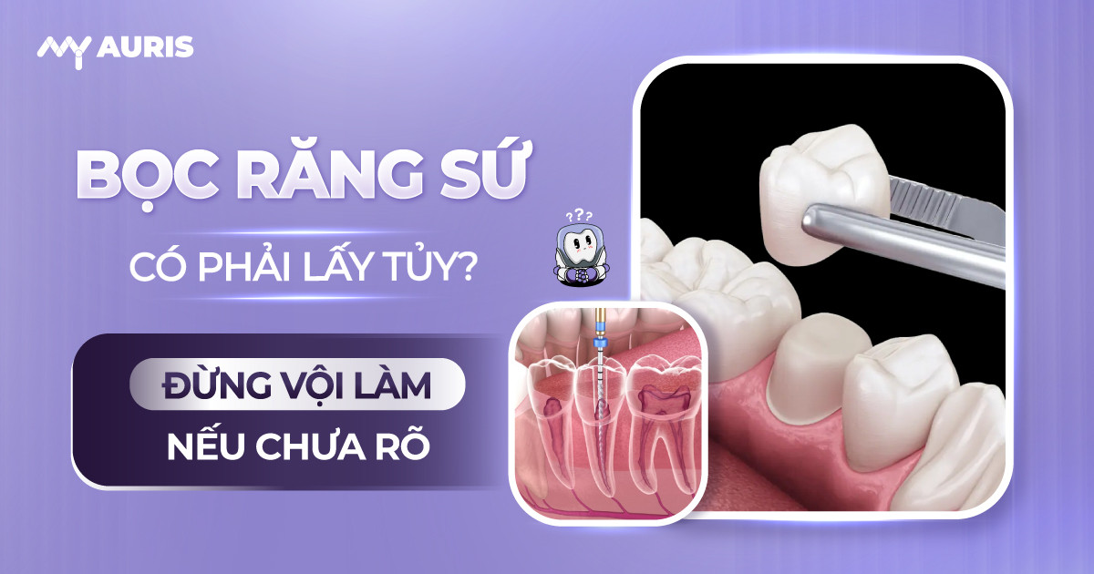 bọc răng sứ có phải lấy tủy