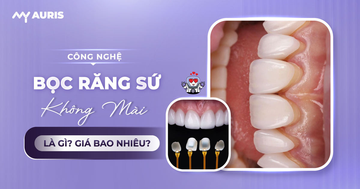 bọc răng sứ không mài