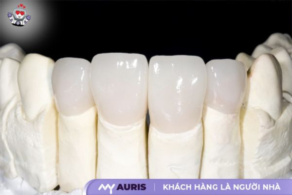 dáng răng sứ đẹp,form răng sứ đẹp,hình ảnh răng sứ đẹp,răng sứ đẹp nhất