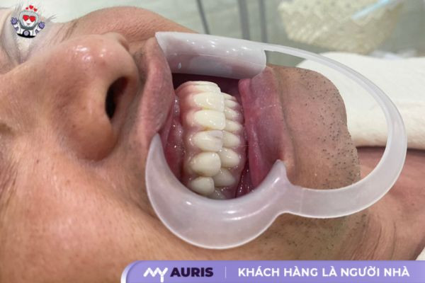 giá làm răng sứ Implant