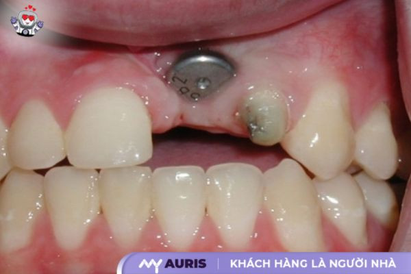 giá làm răng sứ Implant