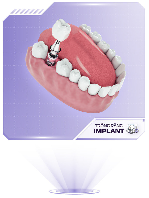 img-site-implant-1