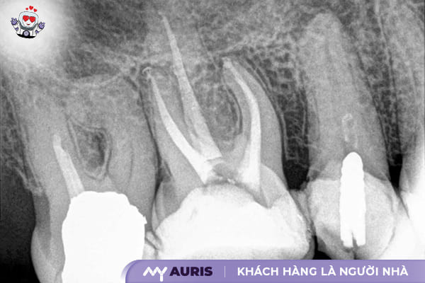 lấy tủy bọc răng sứ giá bao nhiêu,bọc răng sứ bao nhiêu,bọc răng sứ có lấy tủy không,bọc răng sứ giá,bọc răng sứ hết bao nhiêu,chụp răng sứ bao nhiêu tiền,giá bọc răng sứ,giá bọc răng sứ sau khi lấy tủy