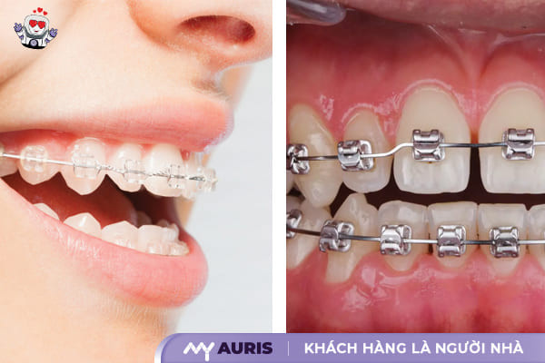 niềng răng sứ là gì, niềng răng sứ