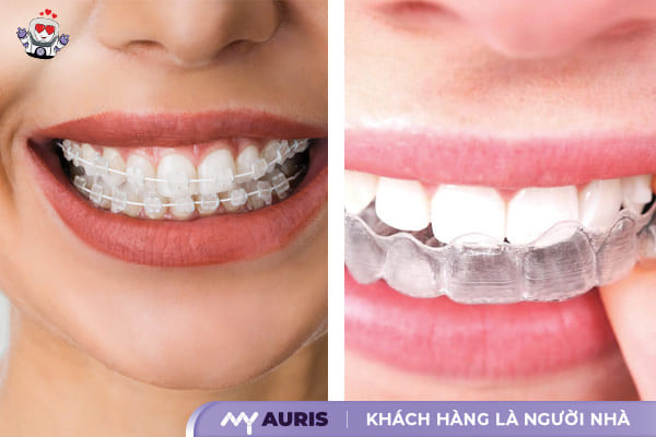 niềng răng sứ là gì, niềng răng sứ