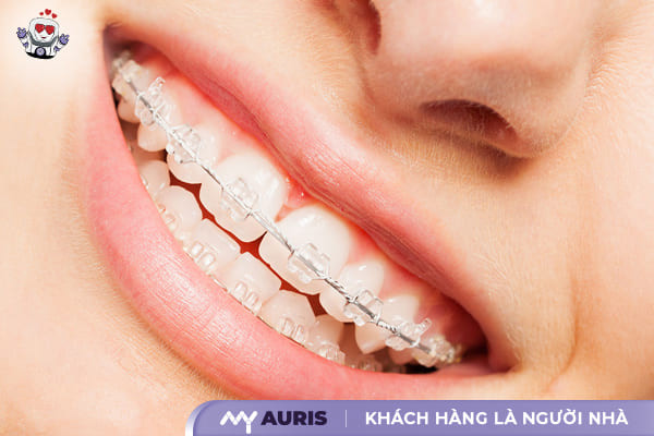 niềng răng sứ là gì,niềng răng sứ