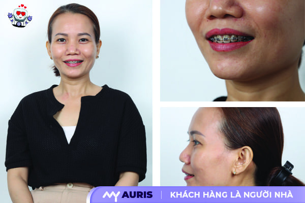 niềng răng sứ là gì, niềng răng sứ
