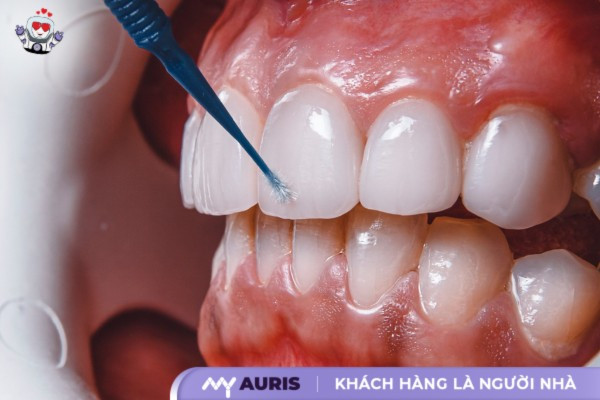 răng sứ zirconia,răng sứ zirconia có tốt không,răng sứ zirconia của nước nào