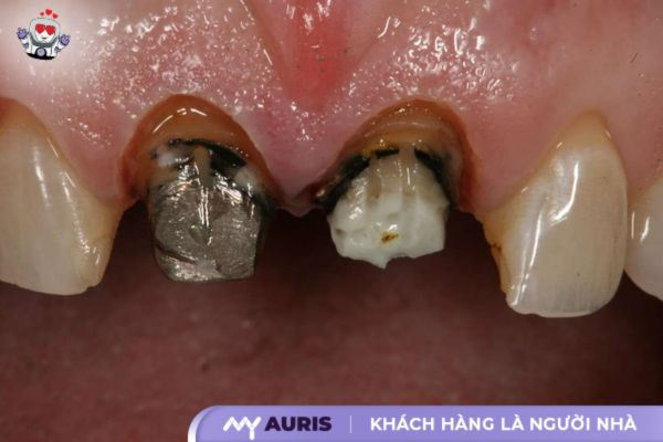 răng sứ kim loại có tốt không, răng sứ kim loại là gì, trồng răng sứ kim loại