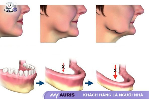 trồng răng giả bị lung lay