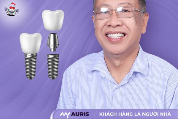 bảng giá trồng răng implant bệnh viện răng hàm mặt