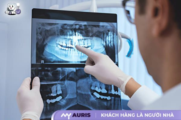 bảng giá trồng răng implant bệnh viện răng hàm mặt