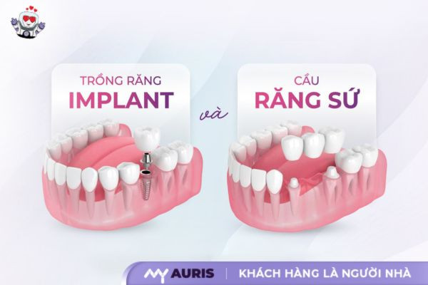 làm cầu răng sứ có đau không