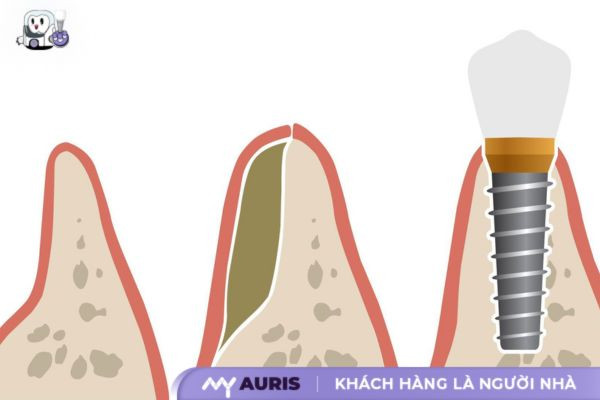 trồng răng implant ghép xương