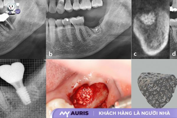 trồng răng implant ghép xương