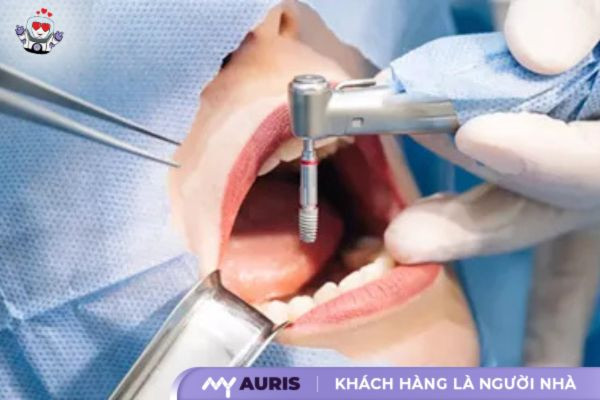 bảng giá trồng răng implant bệnh viện răng hàm mặt