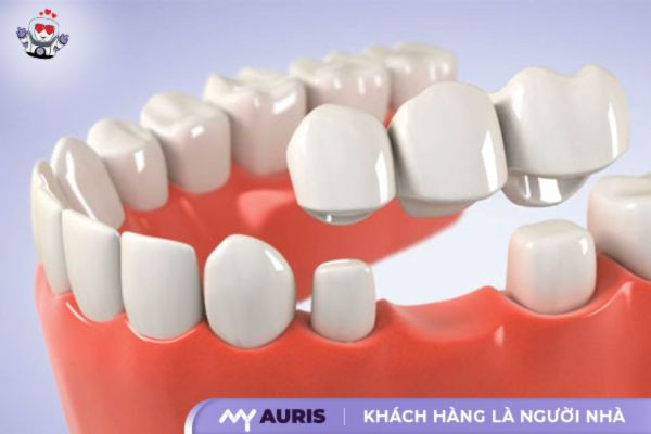 cách trồng răng sứ giả tốt nhất