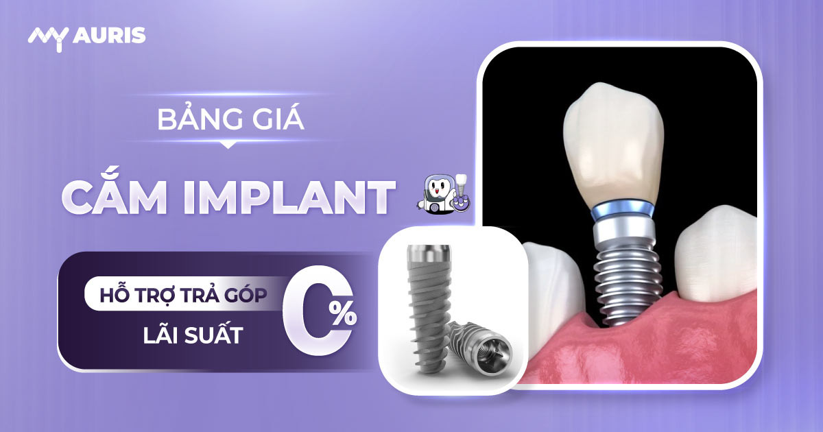 bang-gia-cam-implant