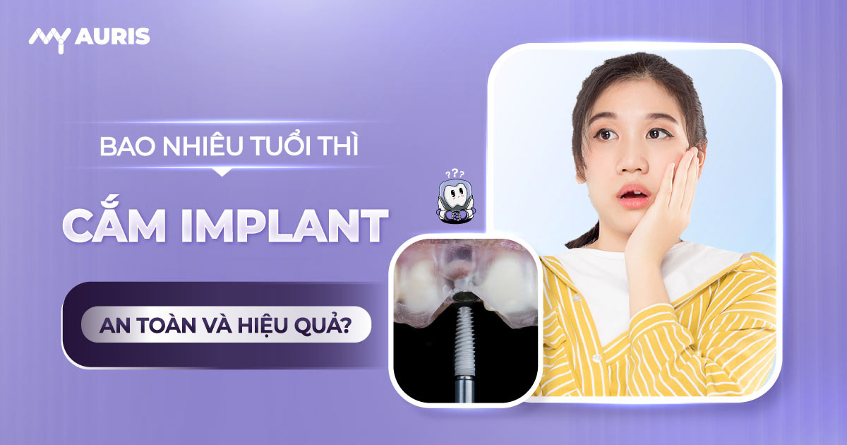 bao-nhieu-tuoi-thi-cam-implant