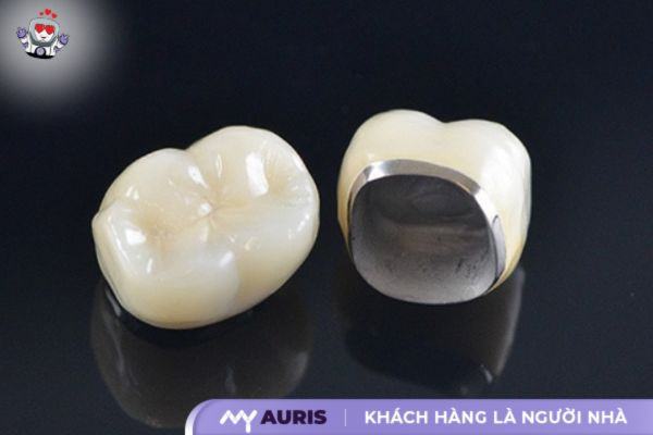 bọc răng sứ kim loại được bao lâu