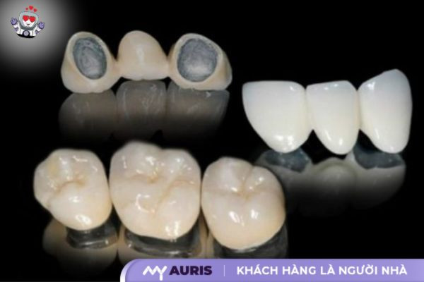 bọc răng sứ kim loại được bao lâu