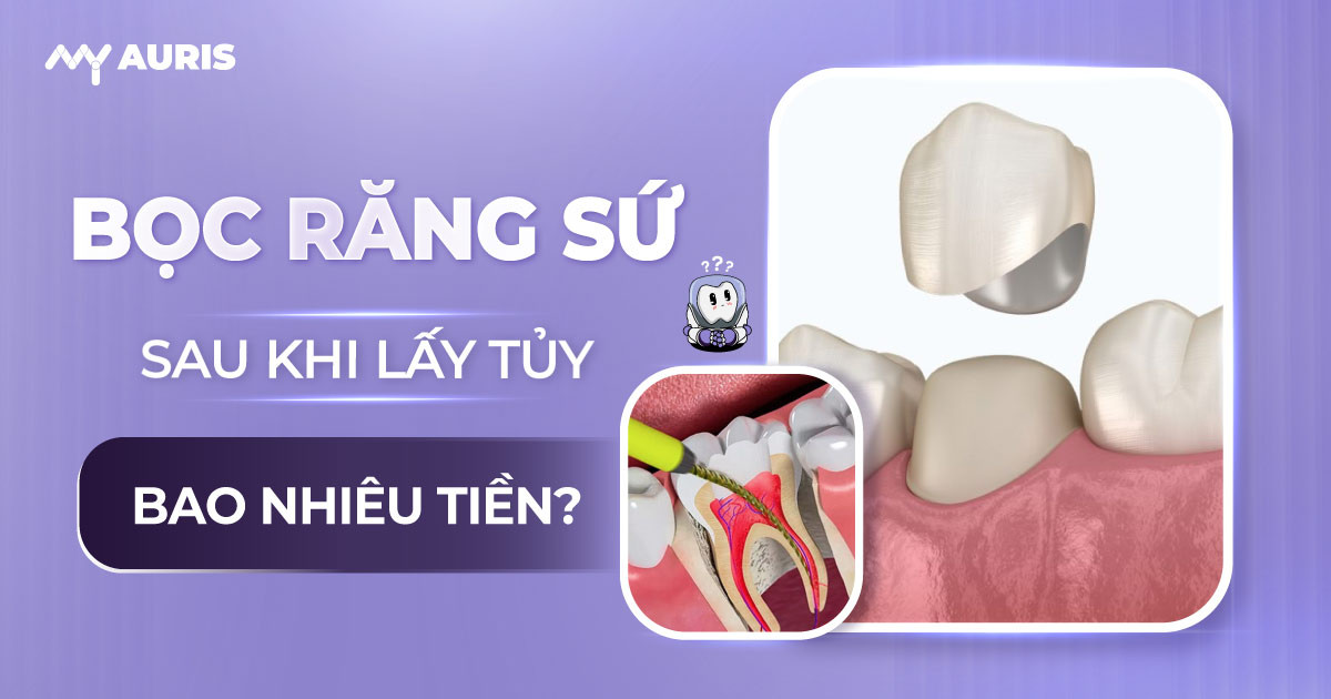 bọc răng sau khi lấy tủy