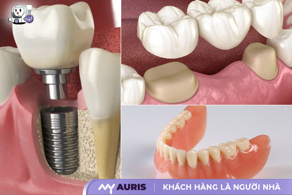 trồng răng vĩnh viễn,các bước trồng răng giả,làm răng implant vĩnh viễn,phương pháp trồng răng sứ vĩnh viễn,trồng răng giả vĩnh viễn,trồng răng hàm vĩnh viễn,trồng răng implant vĩnh viễn