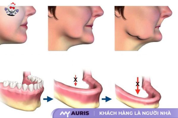 cầu răng sứ và implant