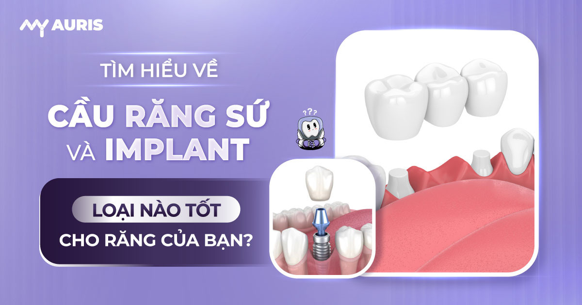 cau-rang-su-va-implant-3-10-24