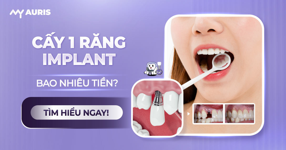 cấy 1 răng implant bao nhiêu tiền