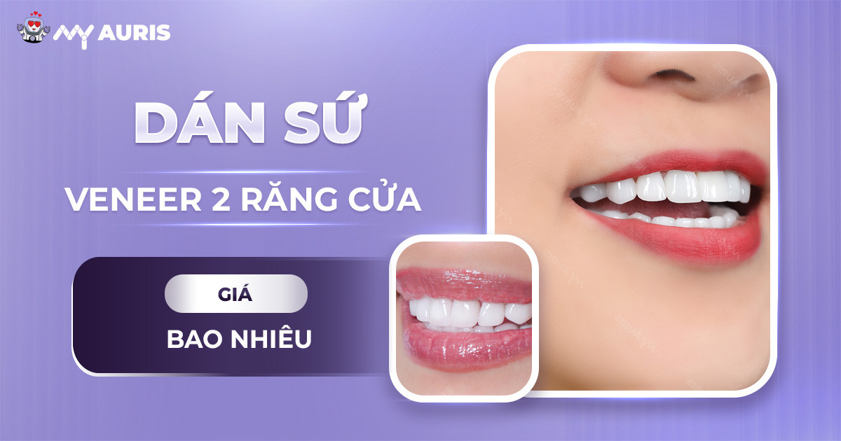 dan-su-veneer-2-rang-cua-gia-bao-nhieu-161024-03