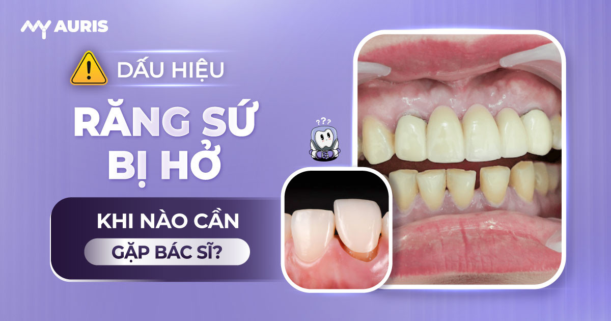 dấu hiệu răng sứ bị hở,răng sứ bị hở, răng sứ bị hở nướu