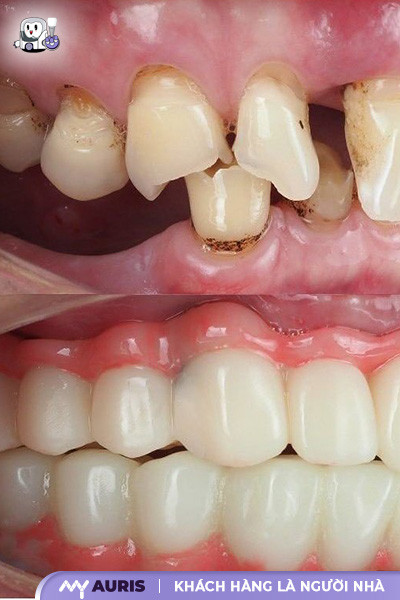 giá trồng răng implant hà nội