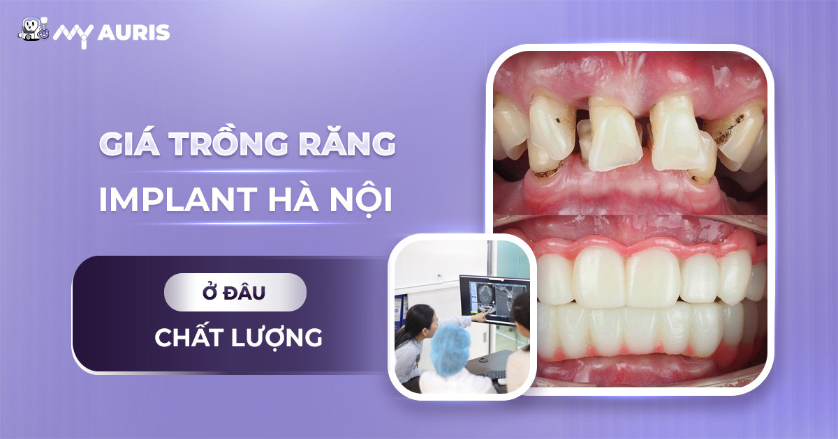 gia-trong-rang-implant-ha-noi-171024-04