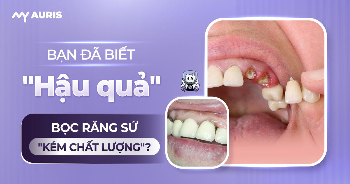 hậu quả bọc răng sứ