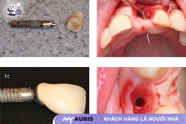 gãy hoặc di chuyển trụ implant