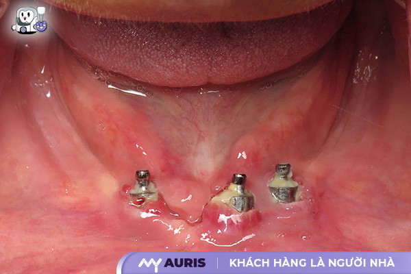 nhiễm trùng implant