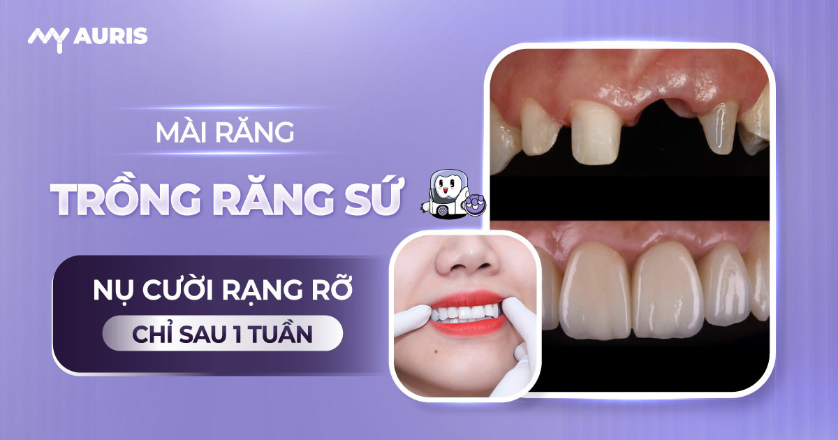 mài răng trồng răng sứ