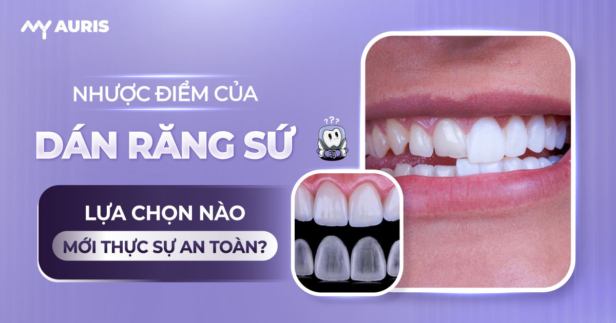 nhược điểm của dán răng sứ