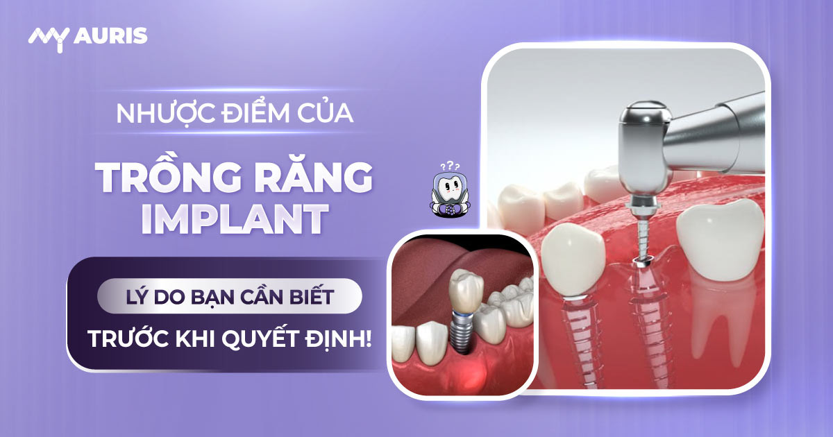 nhược điểm của trồng răng implant